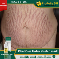 Obat Oles Stretch Mark Herbal Obat Stretch Mark Di Perut Paha Leher Betis Obat Guratan/Garis Di Kuli