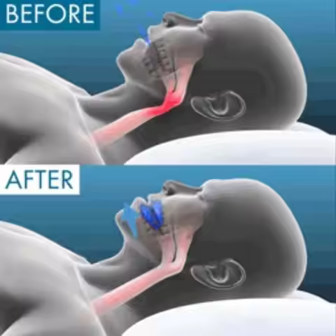 Anti Snoring Mouthpiece Reusable Snore Device Stopper Reduce Snoring Aid Snore Solution Honex Anti S