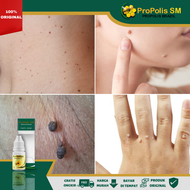 Obat Skin Tag/Papiloma Herbal Obat Daging Tumbuh Di Kulit Obat Penumpas Skin Tag Obat Penghilang Ski
