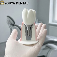 1 Pcs Dental Implant Model Training Teeth Teaching Practice Model Detachable Oral Implant Dentist-Pa