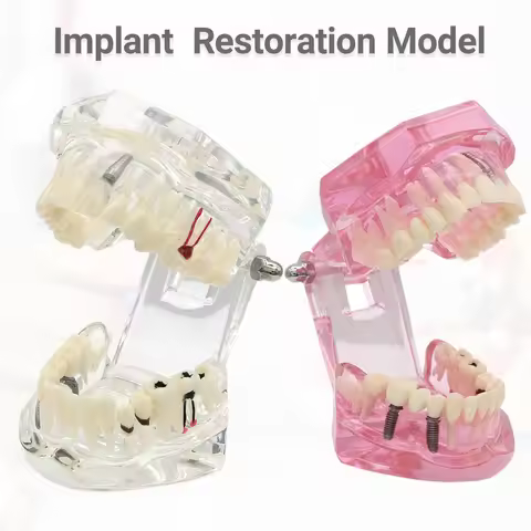 Removable Teeth Models Dental Implant And Restoration Model Dental Model Teeth Implant Restoration B