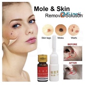 Mole & Skin Tag Removal Solution 100% Strong DIY Remover Skin Tags & Warts & Moles