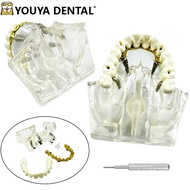 Dental Implant Model 4 Implant Nail Maxillary Sinus Detachable Research Teaching Model