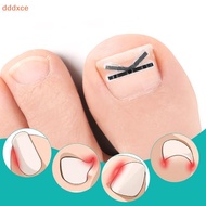 [dddxce] 2pcs Ingrown Toenail Corrector Pedicure Recover Embed Toe Nail Treatment Professional Ingro
