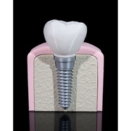 Tooth Implant Model Dental Teaching Model