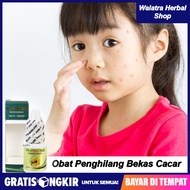 Obat Penghilang Bekas Cacar Air di Wajah - Penghilang Bopeng Bekas Cacar Air - Penghilang Bekas Luka