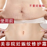Stretch Mark Repair Cream Postpartum Repair Lighten Obesity Lines Remove Growth Lines Remove Obesity