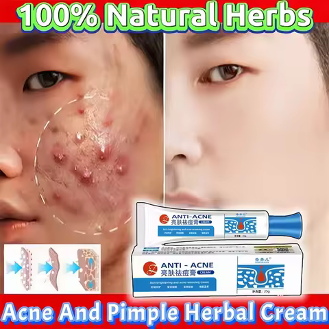 Herbal Acne Removal Face Cream Clears Pimple Scar Black Dots Gel Acne Treatment Shrink Pore Skin Whi