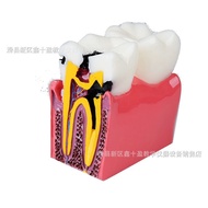 Taoyuan Shipment 6 Times Teeth Model Bad Cavity/Healthy Comparison Demonstration Oral Doctor Patient