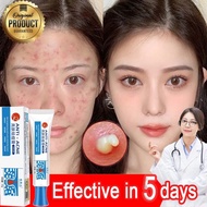 Acne Removal Cream penghilang flek hitam - Salep cina ampuh Penghilang Flek Hitam Membandel Di Wajah