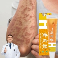 eczema cream krim psoriasis cream ubat gatal ketuat krim eczema treatment antifungal cream itchy kri