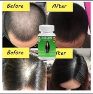 PAKET 5 OBAT BIAR RAMBUT TEBAL OBAT PENUMBUH RAMBUT VITAMIN perawatan rambut rontok rusak dan kering