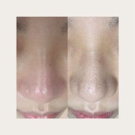 Aqua peel/針清