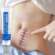 ♀  Fast Removal Scar Cream Lighten Surgical Scars Stretch Marks Acne Pox Prints Burn SmoothTighten Skin Repair Cream Care