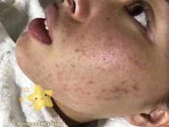OJESh 玻尿酸原液21支連機