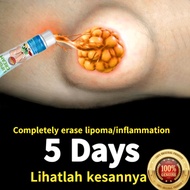lipoma cream benjolan ubat benjolan lipoma removal cream Removal Multiple Single Lipoma Subcutaneous