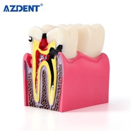6 Times Dental Caries Teeth Model