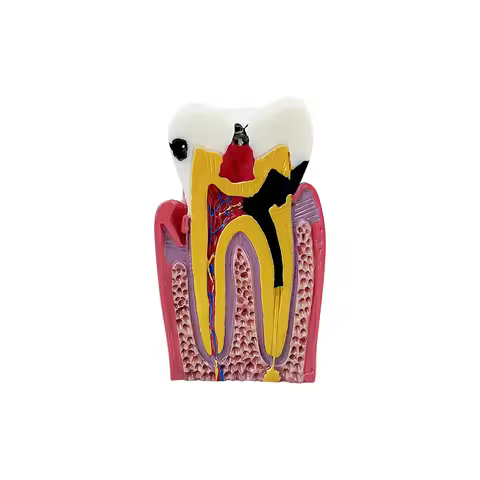 6 Times Molar Pathology Anatomical Model Dental Comparison Model For Dentist Patient Communication E