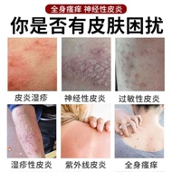 Cure Neuritis Repeated Itching Anti-Itching Special Effects Medicine