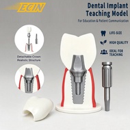 Dental Implant Model Detachable Teeth Teaching Training Practice Model Oral Implant Demo Dentist Pat