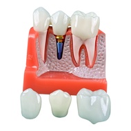 Dental 4 Times Implant Teeth model Demonstration Teeth Model Removable Model Implant Nail Display Mo
