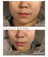 Liftera—V 無針埋線