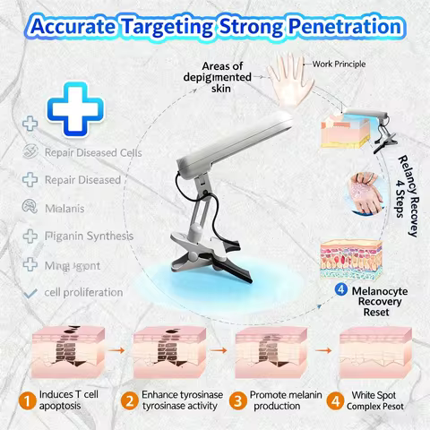 311-Nanometer Medium-Wave Ultraviolet Light Therapy Lamp, Used To Alleviate Symptoms Of Psoriasis An