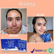 FROZEN COLLAGEN Powder Drink 2 in 1 SKINISTA Pemutih Kulit Wajah Muka Penghilang Jerawat, [BPOM-MUI]