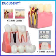KUCUDENT 4/6 Times Dental Teaching Teeth Crown Bridge Caries Compon Model Implant ysis Removabl