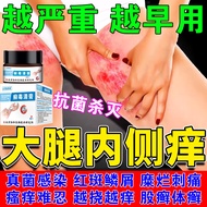 股藓大腿内侧真菌感染股癣专用的药膏皮肤瘙痒止痒湿疹股廯瘙痒红斑脱屑大腿根潮湿瘙痒股癣发黑 单盒【体验装】