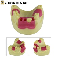 Missing Tooth Implant Practice Model Upper Jaw Dental Model Implant Teeth Model For Studying Trainin