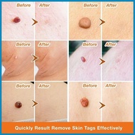 Warts Remover Original Mole Remover Skin Tag Remover Remove Freckles And Melanin Spots