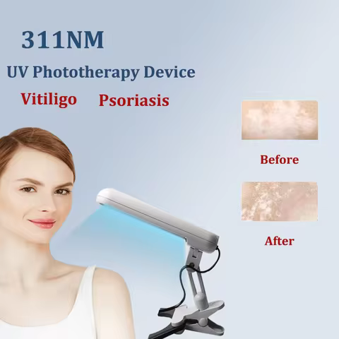 311NM UVB Phototherapy Lamp Device for Vitiligo Treatment UV NarrowBand Ultraviolet Light Therapy Ps