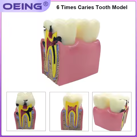 OEING 1Pc Dental Teaching Teeth Model 6 Times Dental Caries Model For Dental Demonstration Model Lab