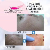 TCA Peel/ Cross treatment Repack 15% to 100% in 2ml to 30ml