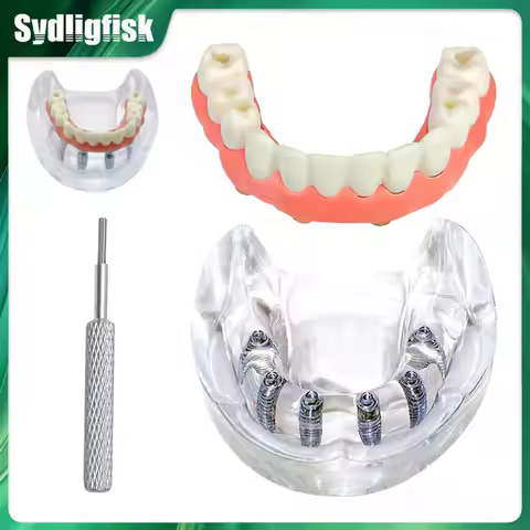 Dental Implant Model Teeth Model 6 Implant Overdenture Restoration Teeth Model Dentist Student Educa