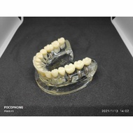 Implant tooth Model