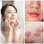 Anti-acne cream, herpes, tomcat. One cream for various benefits.