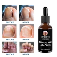 eelhoe nail fungus treatment liquid repair liquid nail fungus treatment liquid repair liquid Nail Tr