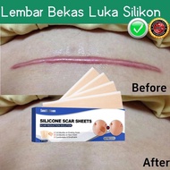 Silicone Scar Sheet Gel 4PCS 4cm x 7.5cm plester silikon penghilang keloid bekas luka Plester Bekas