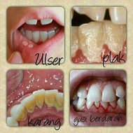 {Ready Stok}_sakit gigi,bengkak gusi,ulser-Guna je ubat gigi