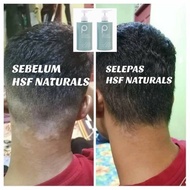 shampoo kelemumur ubat kelemumur kepala syampoo kelemumur anti dandruff dandruff treatment kulit kep