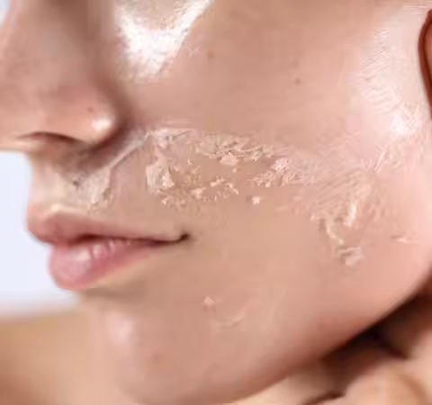 Dilute melanin, acne, 50% TCA, high-quality chemical exfoliation, acidic skin beauty care