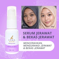 LEIKA SKINCARE Acne Serum, Effective Acne & Acne Scar Removal Serum on the face, Acne Serum