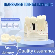 【Fast Shipping】Transparent Dental Implant Model Dental Restoration Model Transparent Removable Patho