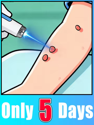 Sell Like Hot Cakes Generation-2 Laser Says Goodbye To all warts In 7 Days