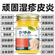 Anti-itch Imported Anti-itch Blister Eczema Eczema Eczema Eczema Eczema Eczema Itching Stubborn Veno