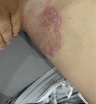 Bôi Da ngứa vùng kín Nấm Ngứa Vùng Kín bên trong đùiNgứa bìu  Hắc Lào - Lác đồng tiền kem Cải thiện 