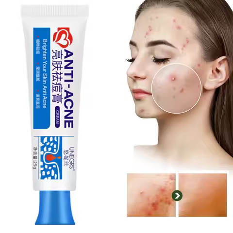 Herbal Acne Removal Face Cream Clears Pimple Scar Black Dots Gel Acne Treatment Shrink Pore Skin Whi