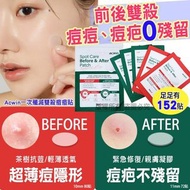 韓國製造 Acwin 一次殲滅雙殺痘痘貼152貼 23/7